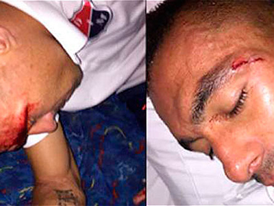 デポルテス・トリーマのサポーターが暴徒化　投石被害で選手が8針縫う大怪我を被る